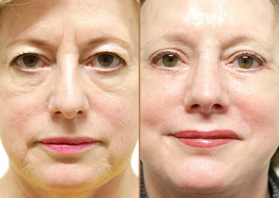 Brow Forehead Lift before and after photos by Sherber and Rad in Washington, DC