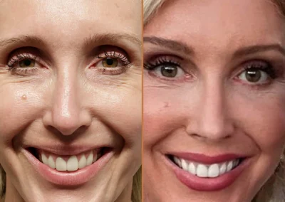 Brow Forehead Lift before and after photos by Sherber and Rad in Washington, DC