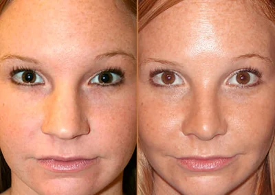 Buccal Fat Removal before and after photos by Sherber and Rad in Washington, DC