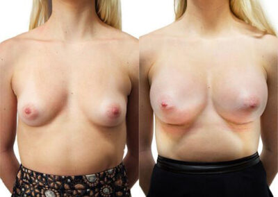 Breast Augmentation before and after photos by Sherber and Rad in Washington, DC