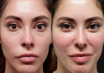 Brow + Forehead Lift before and after photos by Sherber and Rad in Washington, DC