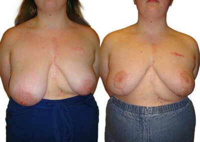 Breast Lift + Reduction before and after photos by Sherber and Rad in Washington, DC