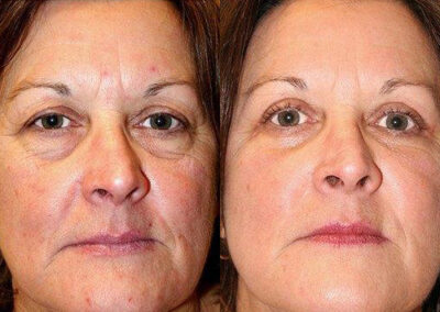 Female Eyelid Lift before and after photos by Sherber and Rad in Washington, DC