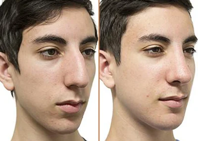 Chin & Jaw Reshaping before and after photos by Sherber and Rad in Washington, DC