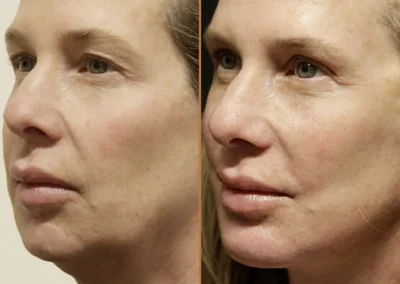 Chin & Jaw Reshaping before and after photos by Sherber and Rad in Washington, DC