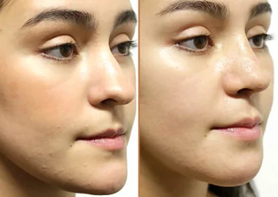 Chin & Jaw Reshaping before and after photos by Sherber and Rad in Washington, DC