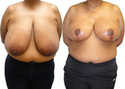 Breast Lift + Reduction before and after photos by Sherber and Rad in Washington, DC