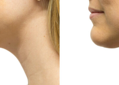 Neck Lift before and after photos by Sherber and Rad in Washington, DC