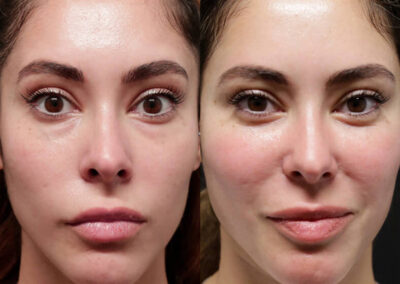 Female Eyelid Lift before and after photos by Sherber and Rad in Washington, DC