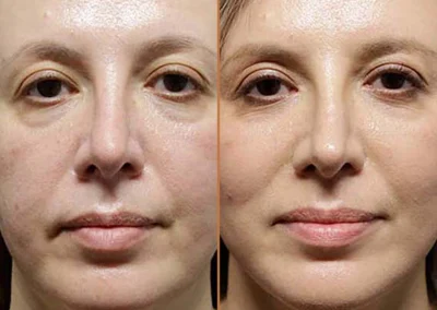 Facial Fat Transfer before and after photos by Sherber and Rad in Washington, DC