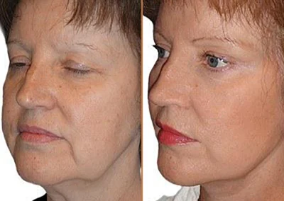 Facial Fat Transfer before and after photos by Sherber and Rad in Washington, DC