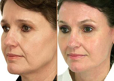 Facial Fat Transfer before and after photos by Sherber and Rad in Washington, DC