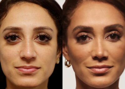 Brow + Forehead Lift before and after photos by Sherber and Rad in Washington, DC
