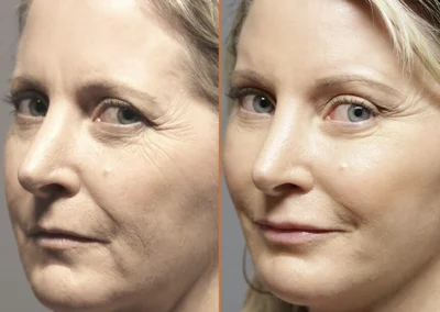 Facial Fat Transfer before and after photos by Sherber and Rad in Washington, DC