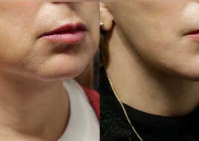 Neck Lift before and after photos by Sherber and Rad in Washington, DC