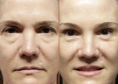 Female Eyelid Lift before and after photos by Sherber and Rad in Washington, DC
