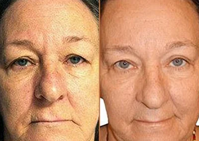 Female Eyelid Lift before and after photos by Sherber and Rad in Washington, DC