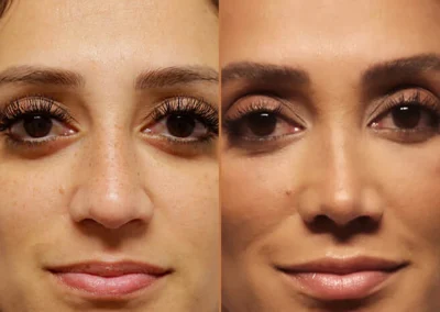 Female Eyelid Lift before and after photos by Sherber and Rad in Washington, DC