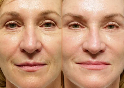 Female Eyelid Lift before and after photos by Sherber and Rad in Washington, DC