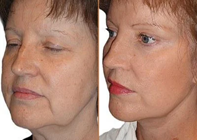 Female Eyelid Lift before and after photos by Sherber and Rad in Washington, DC