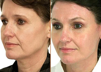Female Eyelid Lift before and after photos by Sherber and Rad in Washington, DC