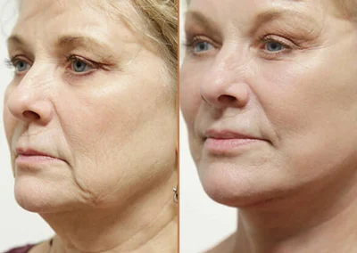 Female Eyelid Lift before and after photos by Sherber and Rad in Washington, DC