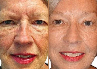 Female Eyelid Lift before and after photos by Sherber and Rad in Washington, DC