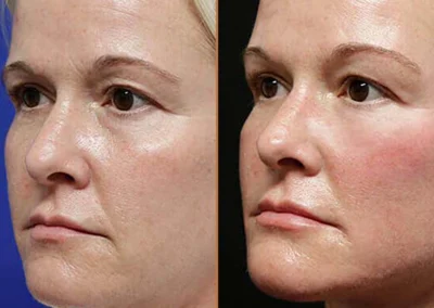Female Eyelid Lift before and after photos by Sherber and Rad in Washington, DC