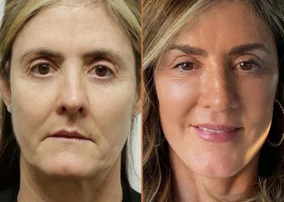 Female Eyelid Lift before and after photos by Sherber and Rad in Washington, DC