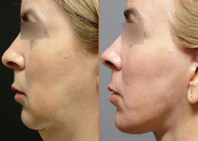 Female Eyelid Lift before and after photos by Sherber and Rad in Washington, DC