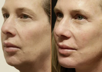 Female Eyelid Lift before and after photos by Sherber and Rad in Washington, DC