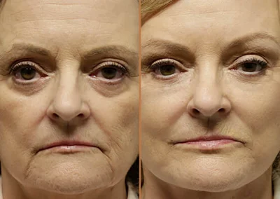 Female Eyelid Lift before and after photos by Sherber and Rad in Washington, DC