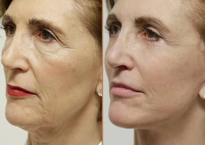 Female Eyelid Lift before and after photos by Sherber and Rad in Washington, DC