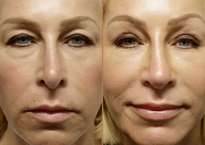 Female Eyelid Lift before and after photos by Sherber and Rad in Washington, DC