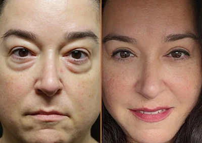 Female Eyelid Lift before and after photos by Sherber and Rad in Washington, DC