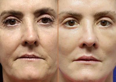Female Eyelid Lift before and after photos by Sherber and Rad in Washington, DC