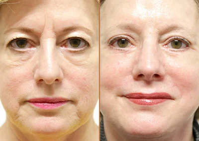 Female Eyelid Lift before and after photos by Sherber and Rad in Washington, DC