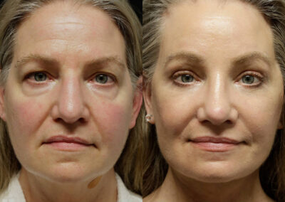 Facial Fat Transfer before and after photos by Sherber and Rad in Washington, DC