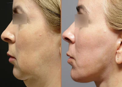Neck Lift before and after photos by Sherber and Rad in Washington, DC
