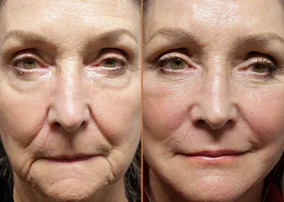 Neck Lift before and after photos by Sherber and Rad in Washington, DC