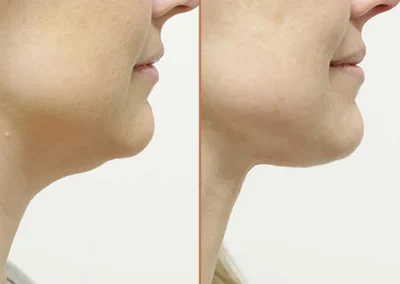 Neck Lift before and after photos by Sherber and Rad in Washington, DC