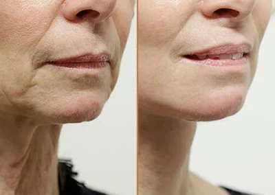 Neck Lift before and after photos by Sherber and Rad in Washington, DC