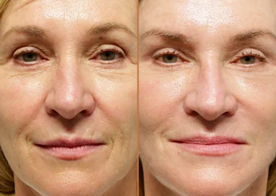 Neck Lift before and after photos by Sherber and Rad in Washington, DC