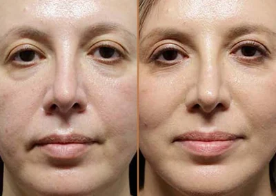 Neck Lift before and after photos by Sherber and Rad in Washington, DC