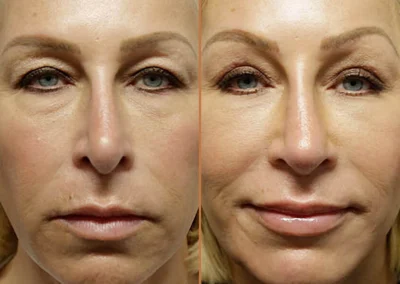 Neck Lift before and after photos by Sherber and Rad in Washington, DC