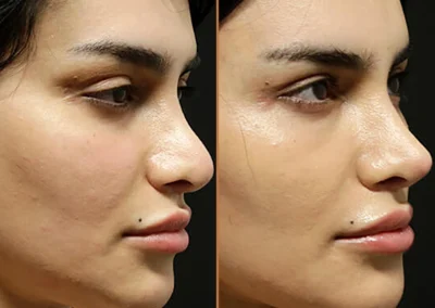 Neck Lift before and after photos by Sherber and Rad in Washington, DC