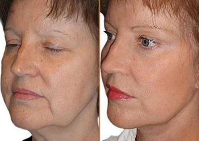 Neck Lift before and after photos by Sherber and Rad in Washington, DC