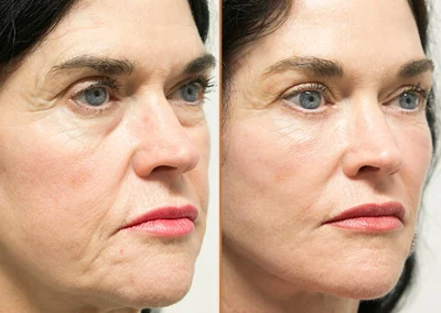 Neck Lift before and after photos by Sherber and Rad in Washington, DC