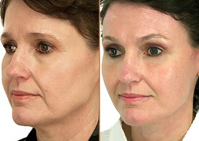 Neck Lift before and after photos by Sherber and Rad in Washington, DC