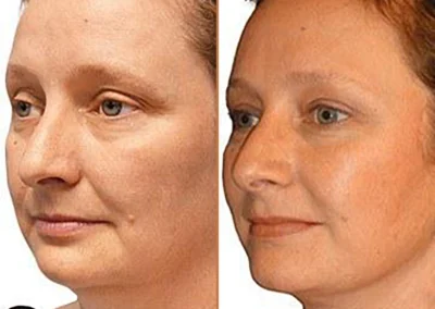 Neck Lift before and after photos by Sherber and Rad in Washington, DC